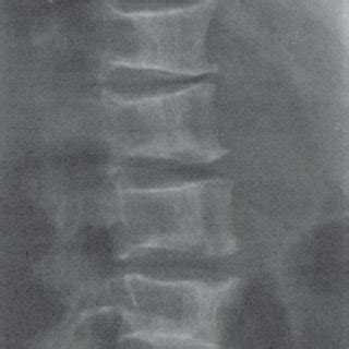 X Ray Of Upper Limb Showing Radial Multifocal Osteomyelitis In A