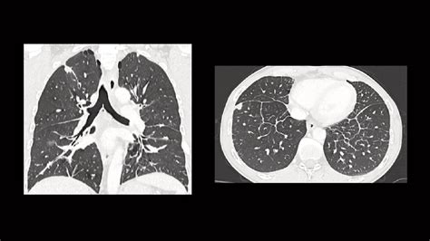 Metastatic Pulmonary Adenocarcinoma Complicated By Pe Siemens Healthineers