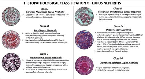 Pdf Pediatric Lupus Nephritis Semantic Scholar