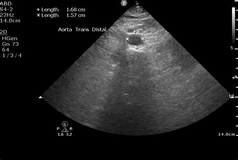 Abdominal Aorta Ultrasound