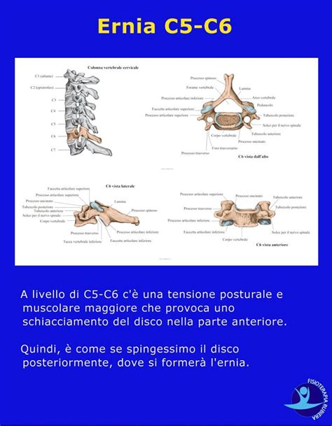 Ernia Del Disco Cervicale I Sintomi Test E La Cura