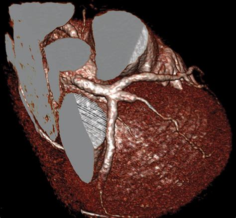 Multidetector Ct For Visualization Of Coronary Stents Radiographics