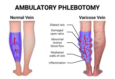 Ambulatory Phlebotomy Health Benefits Member Article By Astra Vein