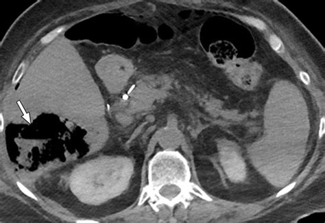 Multimodality Imaging After Liver Transplant Top 10 Important Complications Radiographics