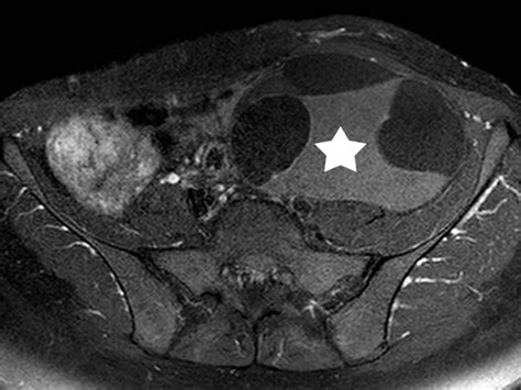 Ovarian Mucinous Cystadenoma Ct And Mr Imaging Findings Eurorad