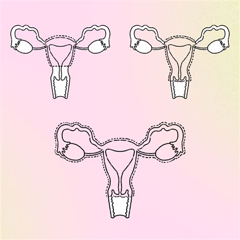 Folx Health Transgender Hysterectomy Guide