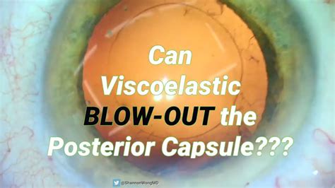 Can Viscoelastic BLOW OUT The Posterior Capsule During Routine Cataract