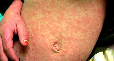 Measles in the U.S. and the MMR (Measles, Mumps, Rubella) Vaccine ...