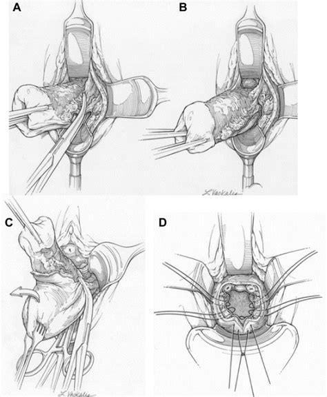 Total Vaginal Natural Orifice Transluminal Endoscopic Surgery