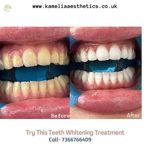 5 Key Reasons You Should Undergo Teeth Whitening Treatment - Kamelia ...