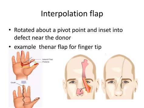 Types of flap | PPT