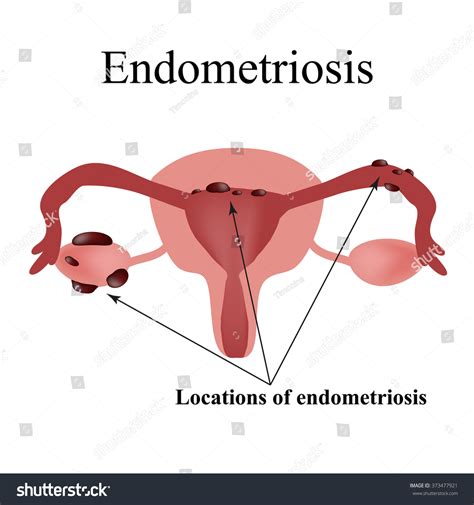 Endometriosis Endometrial Cysts Structure Pelvic Organs Stock ...