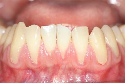 Understanding Periodontitis And The Latest Classification System