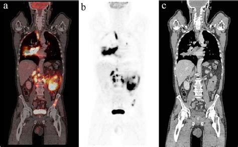 A Coronal Slice Of Fused PET CT Image A The Corresponding PET Image