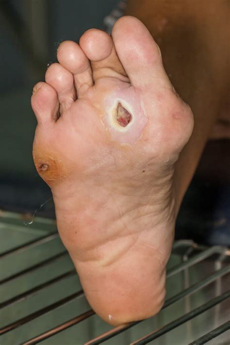 Foot Ulcers OSCEstop OSCE Learning