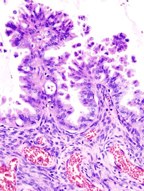 Filemucinous Borderline Tumor Of Ovary 1 Histopatholgy