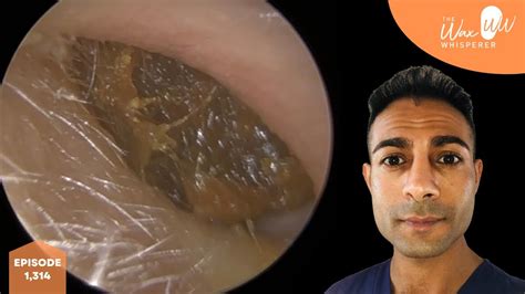 1314 Huge Ear Wax Removal From Small Ear Youtube