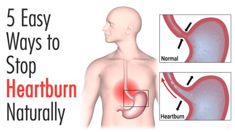 how to stop heartburn at home