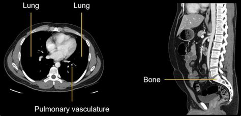 Abdominal CT Windows Basics LITFL Radiology Library