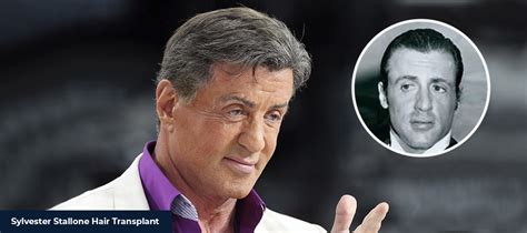 10+ Sylvester Stallone Hair Transplant - UmarKounain