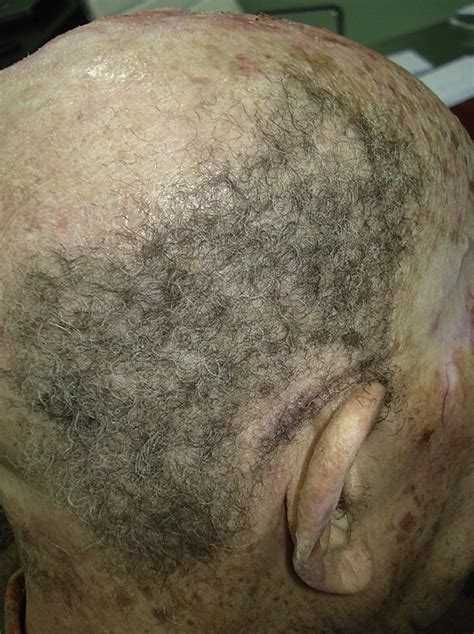 Cetuximab Induced Hypertrichosis Of The Scalp And Eyelashes Journal Of The American Academy Of