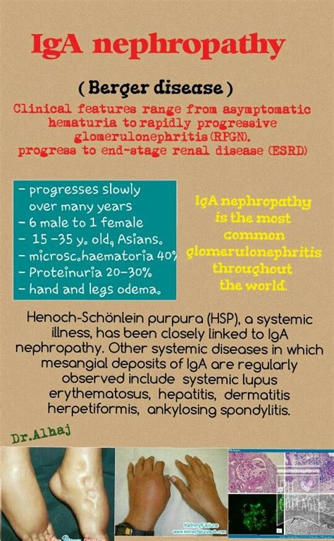 IgA nephropathy is the most common glomerulonephritis throughout the ...