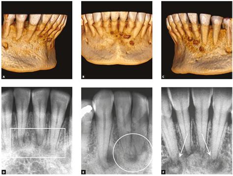 Periapical Cemental Dysplasia Stages