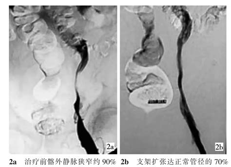 植入支架治疗恶性肿瘤压迫致髂静脉狭窄14例参考网