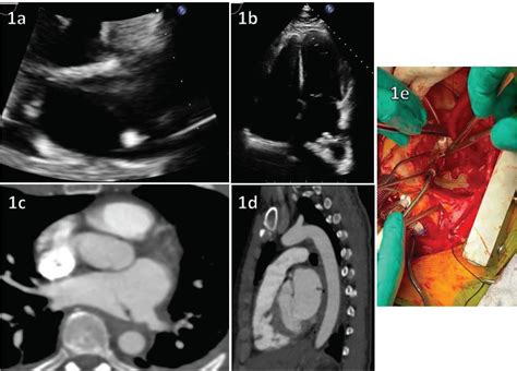 WHEN THE HEART MEETS THE ESOPHAGUS A CASE OF ATRIOESOPHAGEAL FISTULA