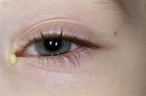 Bacterial Conjunctivitis: Causes, Symptoms, Signals and Treatment ...