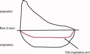 Spirometry/flow volume loop. The forced vital capacity is a measurement ...