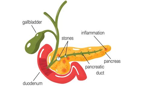 A Guide To Pancreatitis