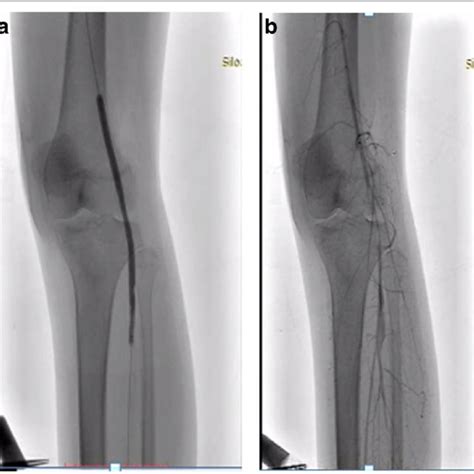 A Multiple Plain Old Balloon Angioplasty Dilatations B Flow After