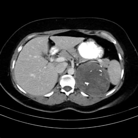 Computed Tomographic Scan Of Left Adrenal Mass Download Scientific