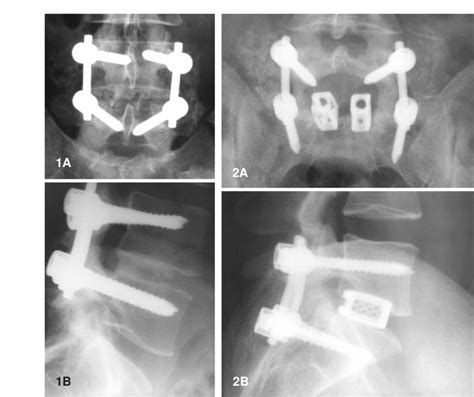 Lumbar Interbody Fusion