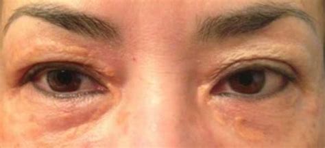 Xanthelasma Xanthomas Eyelid Cholesterol Deposits