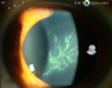 Atlas Entry Varicella Zoster Virus Vzv Epithelial Keratitis