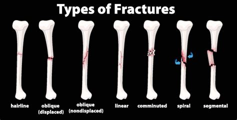 Types Of Fractures The Things You Need To Know Opa