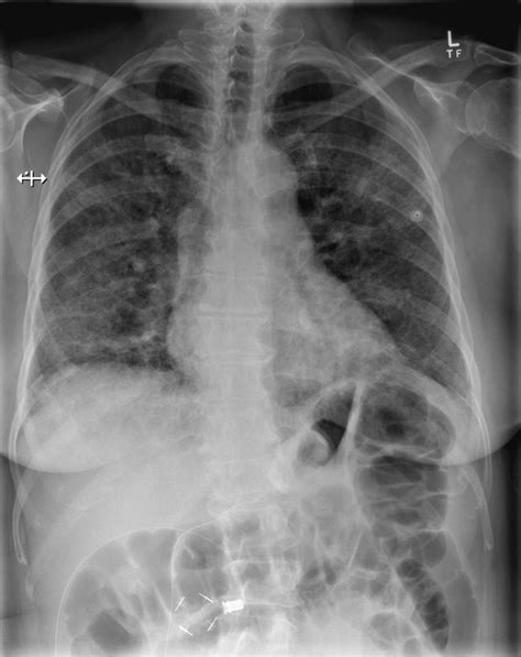 Fat Embolism Syndrome Ct Wikidoc