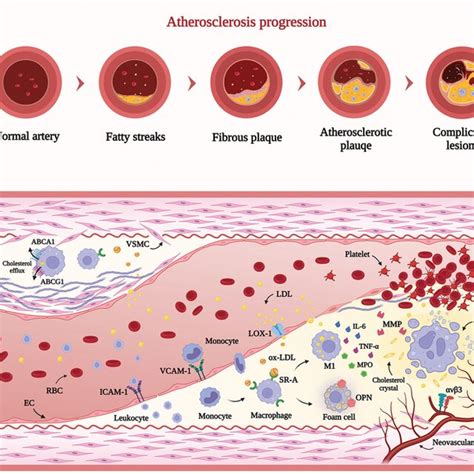 Schematic Illustration Of The Development Of Atherosclerosis And