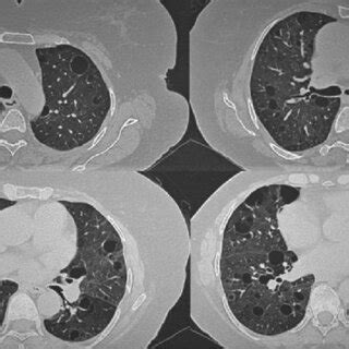 CT scan of the chest | Download Scientific Diagram