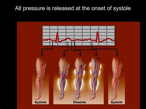 Enhanced External Counterpulsation Eecp Role In Ppt