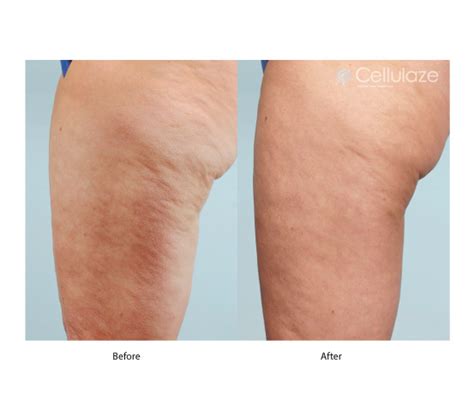 Cellulaze The Med Spot