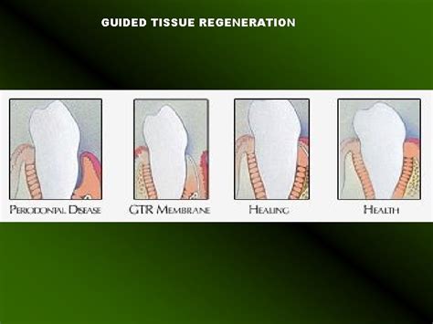 Guided Tissue regeneration and Guided Bone Regeneration Guided