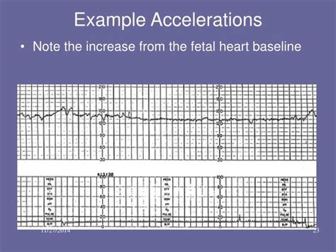 Ppt Basic Fetal Monitoring Review Powerpoint Presentation Id 6960616