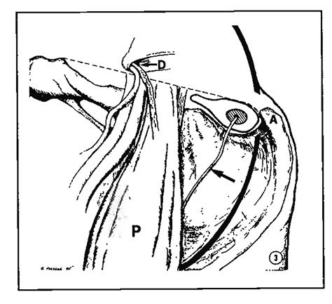 Figure 3 From The Clinical Anatomy Of Laparoscopic Inguinal Hernia Repair Semantic Scholar