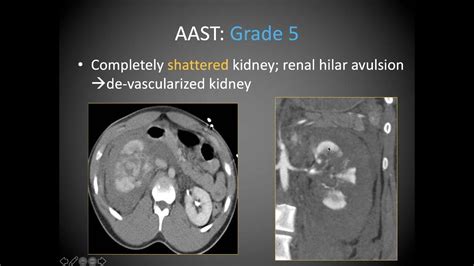 Imaging Findings In Urinary Tract Trauma Youtube