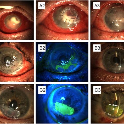 Epithelialization Of A Corneoscleral Tectonic Graft Case 6 After