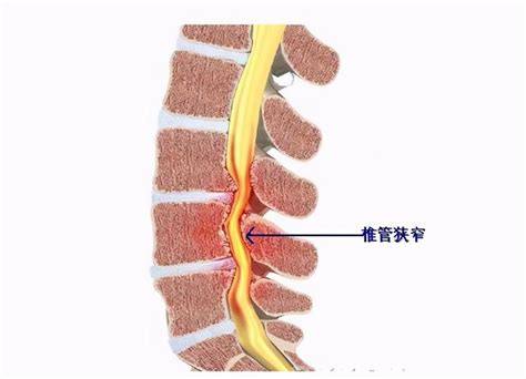 腰椎間盤突出症和椎管狹窄，這兩者有啥區別？治療上有何不同？ 每日頭條