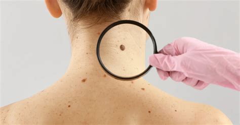 Dermatologist Warns About Increase In Non Sun Exposed Skin Cancer Cases